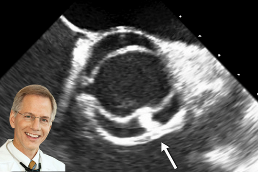 Transesophageal echocardiogram of a bicuspid aortic valve. Dr. Braverman is superimposed over the image and is wearing a white doctor's coat.